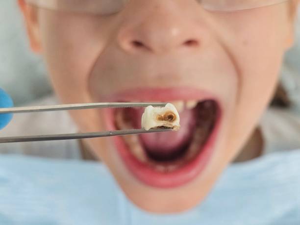 Best Emergency Dental Care for Broken or Chipped Teeth in Canby, MN